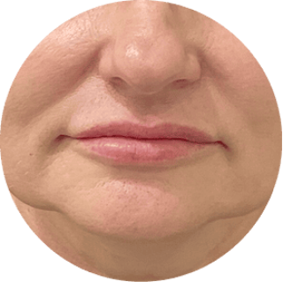 HÄNGENDER KIEFERBEREICH