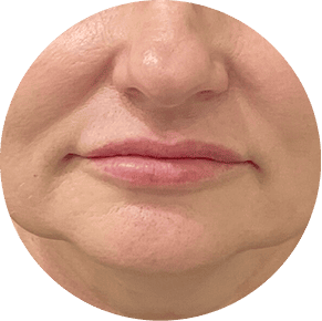 Sagging Jawline