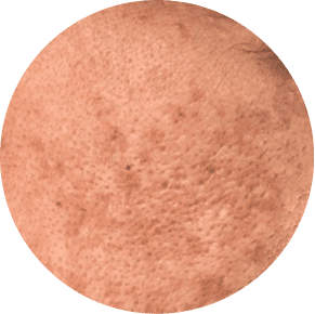 Sun Damage