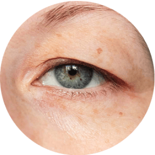 HÄNGENDE AUGENLIDER