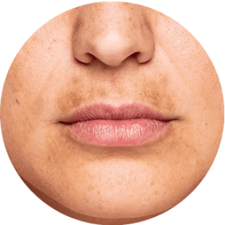 UNEBENMÄSSIGER HAUTTON