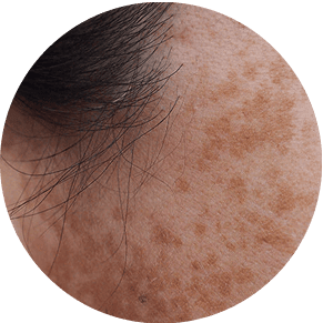 Dark Spots