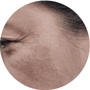Dull Complexion