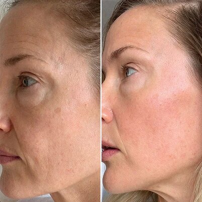 GloraMD Result Before After