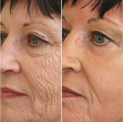 GloraMD Result